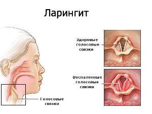 Ларингит