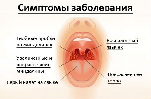 Симптомы ангины