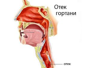 Отек гортани