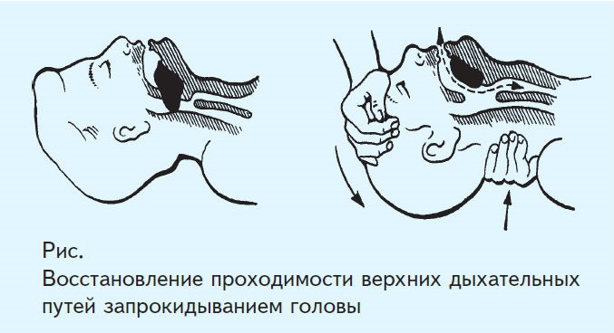 Запрокидывание головы при первой помощи