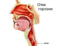 Отек гортани