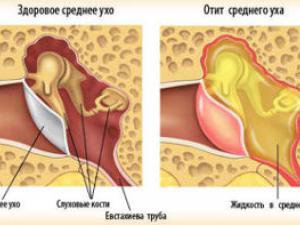 Отит среднего уха