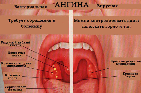 Отличия бактериальной и вирусной ангины