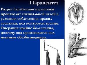 Парацентез барабанной перепонки