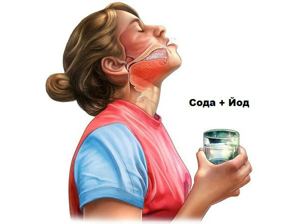 Полоскание горла йодом и солью