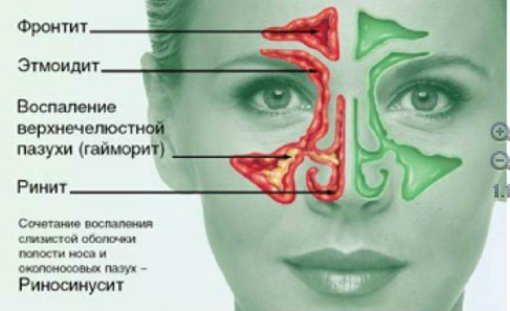 Синуситы Синуситы