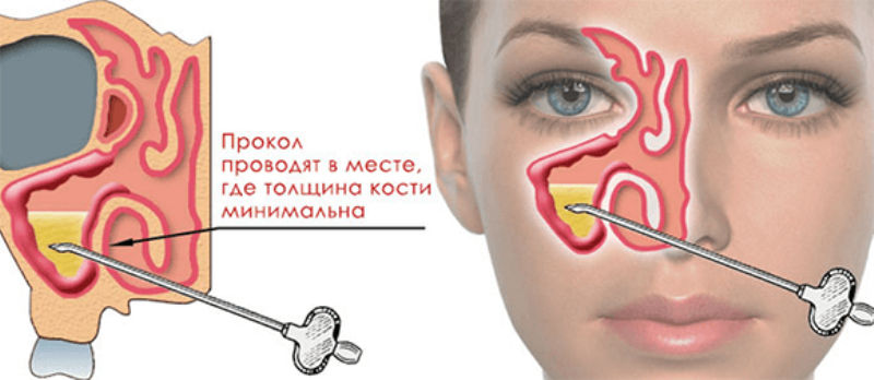 Прокол гайморовой пазухи