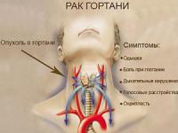 Рак гортани