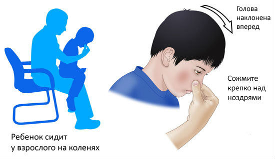 Остановка носового кровотечения