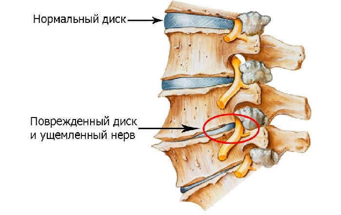 Ущемление нерва в позвонке