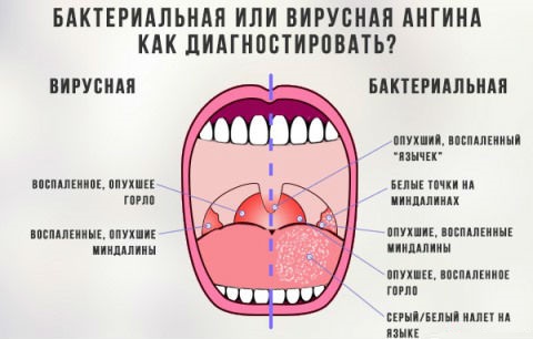 Виды ангины