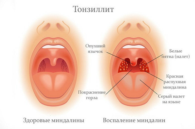 Тонзиллит