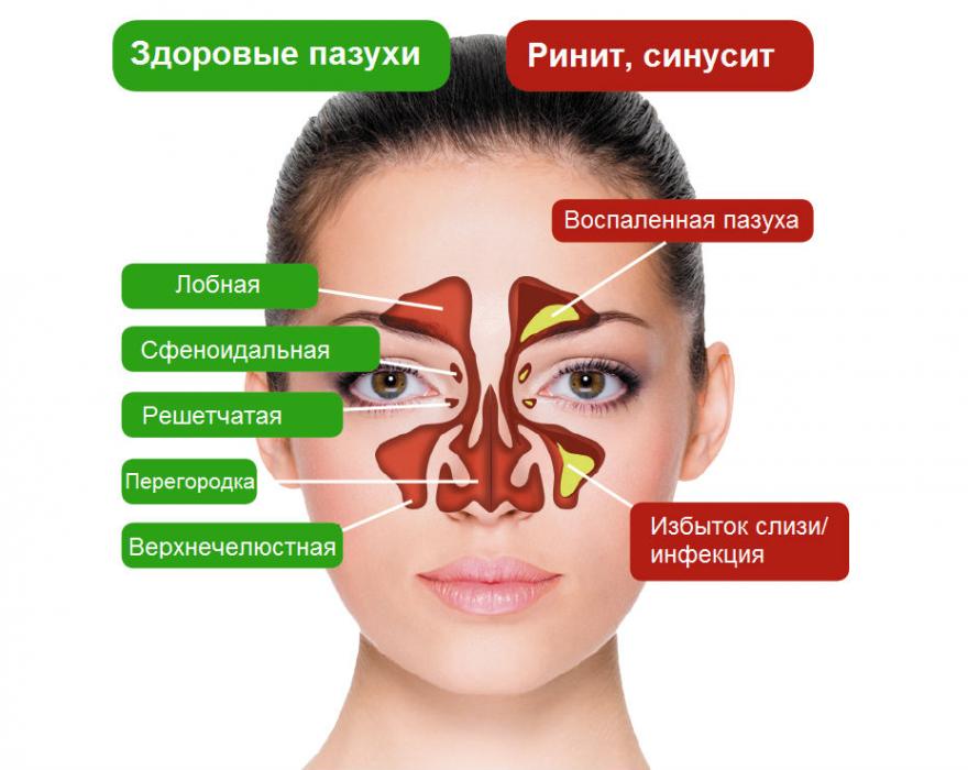 Синусит
