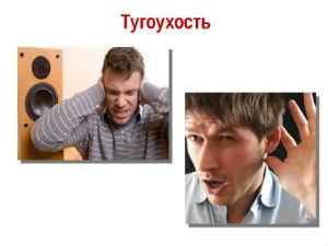 Тугоухость