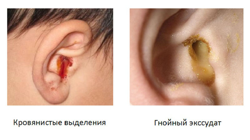 Оторея