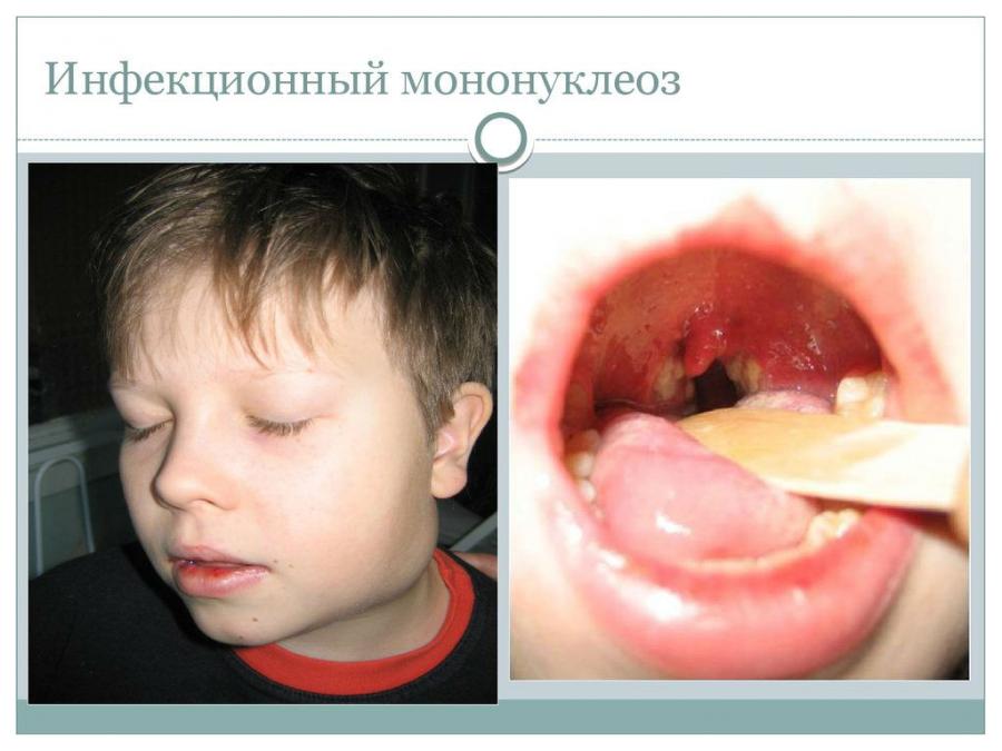 Инфекционный мононуклеоз