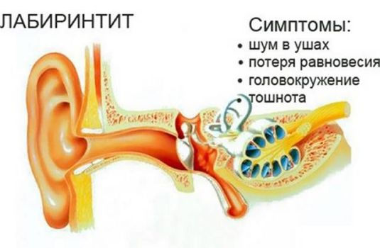Развитие лабиринтита