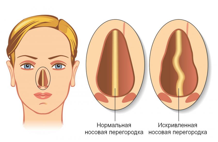 Искривление перегородки носа