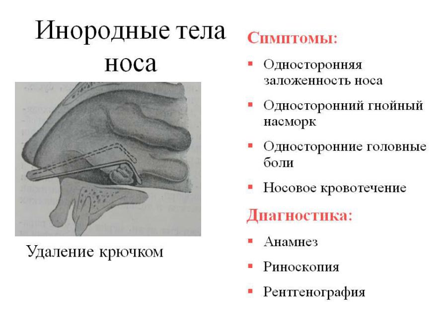 Инородные тела носа