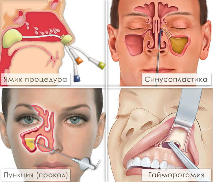 Лечение околоносовых пазух