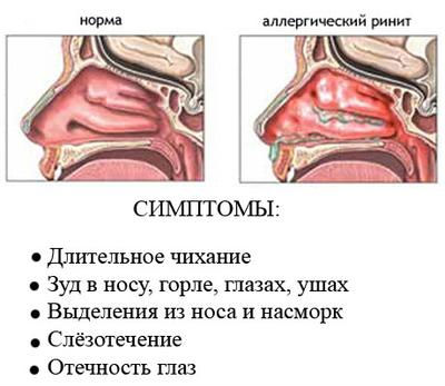Аллергический насморк Аллергический насморк